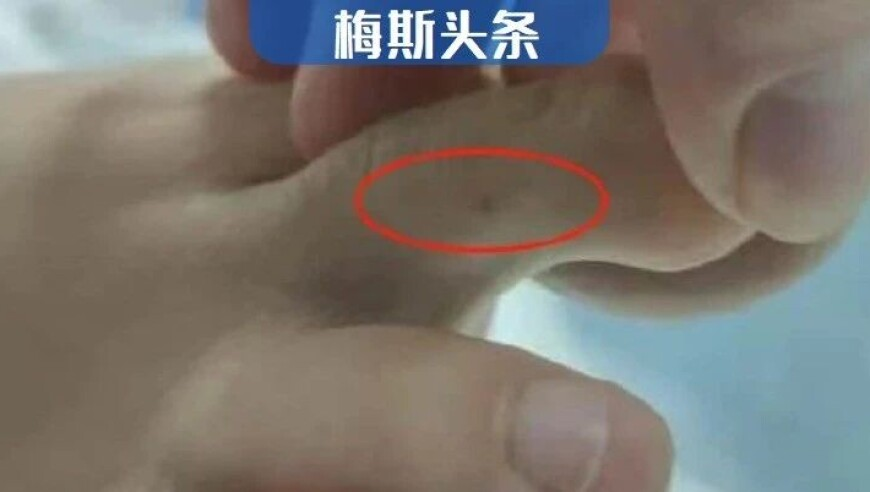 澳门四肖八码期期准精选资料软件,加拿大首例“以牙换眼”手术开启,权威独家讨论与热门话题_手机版V9.50